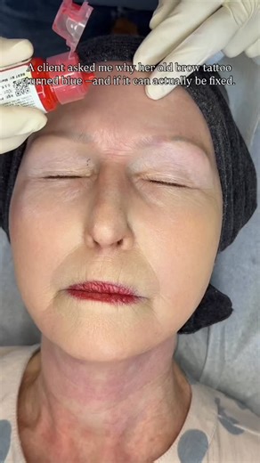✨ These are the key things I always explain when correcting old brows that have turned blue or red: ✨ First, I clarify that blue or red tones usually appear in older brow tattoos, when the original pigment fades over time and reveals its underlying tone. This is often influenced by the pigment used years ago, the depth of the work, and how the skin healed — not because brow tattooing itself is “bad.” ✨ I’m very clear that correcting blue or red brows is not about adding more pigment to cover the
