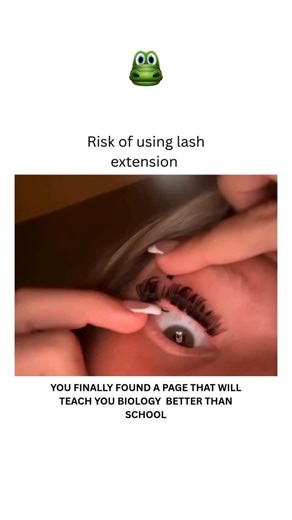 BIOLOGY | MEDICAL | HEALTH on Instagram: "Using lash extensions can lead to allergic reactions, eye irritation, or infections if not applied properly. Improper application or removal can also damage natural lashes, leading to breakage or loss. Regular maintenance is necessary to prevent these risks. Dm for credit or removal 👏🏻🙏🏻 For educational purposes only……… #viral #explore #biology #science #knowledge #bio #lashextensions #harms #eyecare #explorepage #eyevision #visioncare"