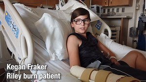 3.1K views · 52 reactions | A central Indiana family is sharing a warning after their son suffered a serious burn to his hand due to falling onto a fire pit. While there were no visible flames a the time of Kegan Fraker's fall, the temperature of the fire pit was hot enough to cause a significant injury. Now, Kegan and his parents want others to be aware of any fire pits this summer so they don't have to go through a similar situation. | Riley Children's Health | Facebook