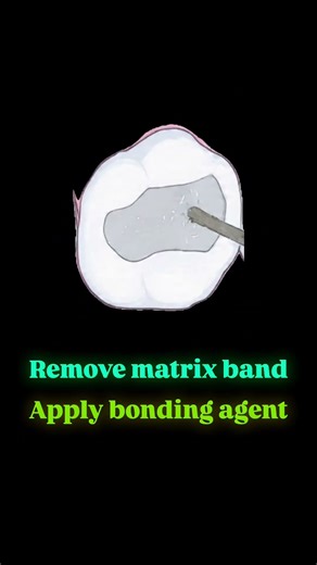 Class II Composite Restoration – Step by Step 🦷| Dr.Dentique-hub