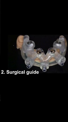 Stackable guides in implant surgery