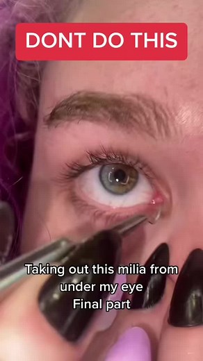 Removing Milia Under Eye by Dermatologist | Eye Bumps Treatment