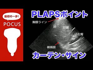 PLAPSポイント・カーテンサイン(curtain sign)【POCUS・肺ポイントオブケア超音波】