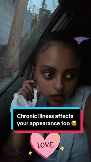 This was all from treatments. Now think about the impact of the pain & fever on your appearance too. It's annoying. #ethiopian_tik_tok🇪🇹🇪🇹🇪🇹🇪🇹 #pilly #fyp