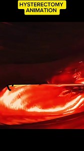 HYSTERECTOMY ANIMATION ' Disclaimer: This video is for educational purposes only and is intended to raise awareness about medical procedures. It does not violate community guidelines and contains no graphic or harmful content. #hysrerectomy #HysterectomyAwareness #HysterectomyJourney #HysterectomySupport #vNOTESHysterectomy #vNOTES #MinimallyInvasiveSurgery #HysterectomyRecovery #WomensHealth #SurgicalInnovation #vNOTESTechnique #WomenEmpowerment #HealthEducation #MedicalFacts #AnimationEducatio