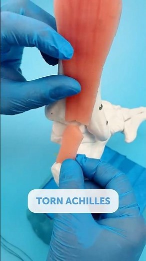What Happens When Your Achilles Snaps?