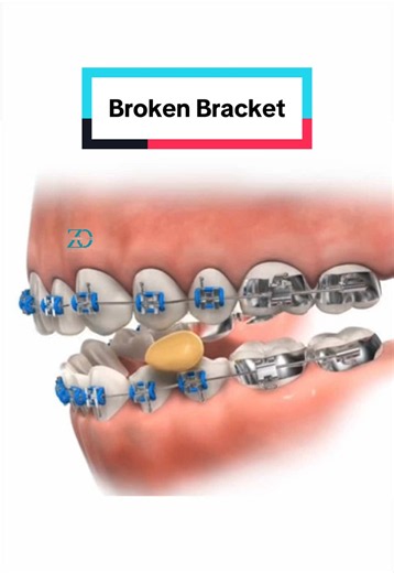 Broken bracket? 😳 Here’s what we do about it . . . #braces #braceson #bracestips #brokenbrackets