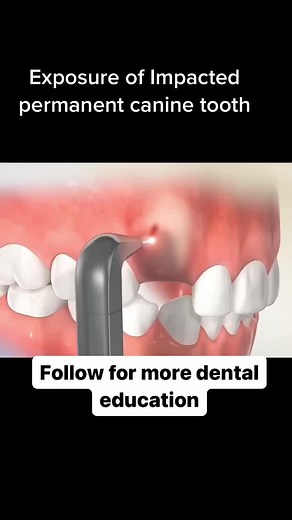 An impacted tooth essentially means that it is blocked, stuck, or unable to fully erupt and function properly#canine #Tooth #Dentistry #ortho #Braces #Orthodontics #Orthodontist