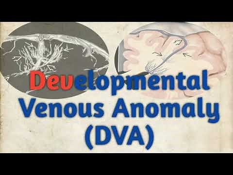 Case Report- Developmental Venous Anomaly (DVA)/CT BRAIN 🧠/ Radiology 2.0.......