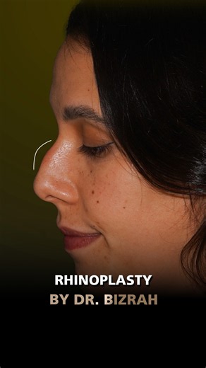 Before & After Rhinoplasty: Transforming a Nose Hump & Drooping Tip by Dr. Bashar Bizrah