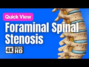 Foraminal Stenosis & Foraminotomy | 3D Spine Animation (No Narration)