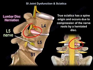 Sacroiliac Joint Dysfunction vs. Sciatica: Understanding SI Joint Pain Resembling Spine Pain and Sciatica • Video • MEDtube.net