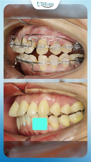 Ngỡ Ngàng Răng Hô Chuẩn Khớp Cắn Sau Khi Niềng Răng | Nha Khoa Minh Châu