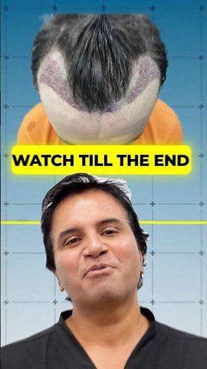 Hair Transplant WITHOUT Shaving? (No-Shave FUE Explained!)