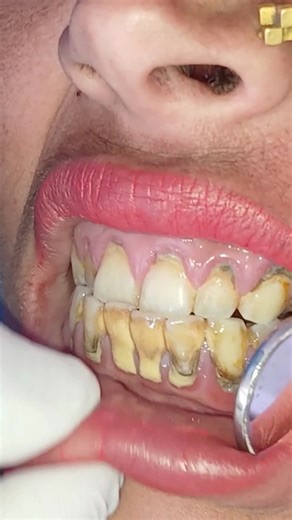 Nepalidentist | 🦷 Dirty Teeth with Heavy Calculus & Plaque – Why It Happens Plaque is a soft, sticky layer of bacteria. When not cleaned properly, it... | Instagram