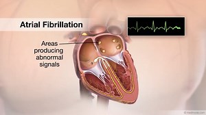 Medmovie Cardiovascular Video Library - cvml_0080a Atrial Fibrillation 1280x720