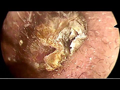oung Man’s Ear Blocked by Massive Earwax | Doctor Anh