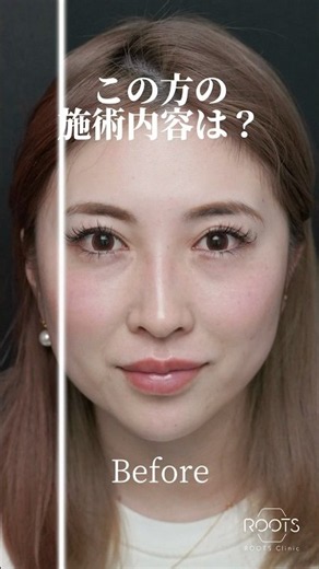 【30代女性クマ治療】 #クマ治療 #クマ取り #目の下のクマ #裏ハムラ #rootsclinic