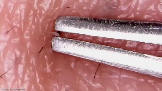 Disgusting footage shows a host of blackheads being pulled out