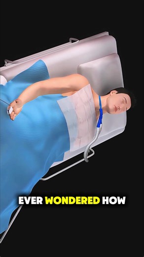 How Tracheotomy Surgery Is Done(3D Animation) Tracheotomy surgery is performed to create an opening in the trachea to help a person breathe. The surgeon makes a small incision in the front of the neck and carefully opens the windpipe. A tracheostomy tube is inserted into the opening to allow air to pass directly into the lungs. This procedure is used when the normal airway is blocked or long-term breathing support is needed. #tracheotomy #tracheostomy #airwaysurgery #medical3d #3danimation