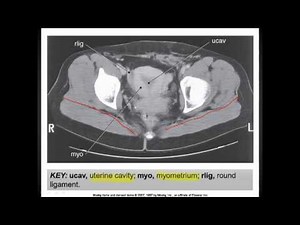 The Pelvis (CT Anatomy).mp4