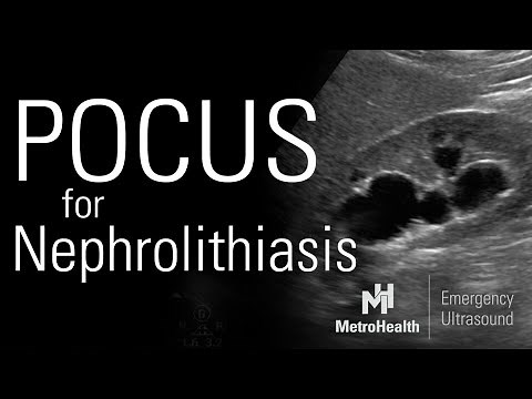 POCUS for Nephrolithiasis