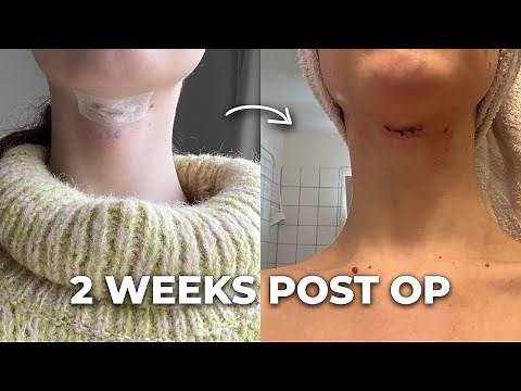 Tracheal Shave Recovery | mtf transition