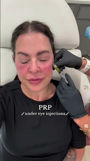 PRP under eye injections