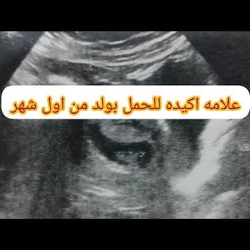 # شكل كيس الحمل بالجنين الذكر من أول شهر💗💗