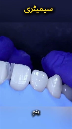 Midline space Closure: The Art of the Perfect Smile #shorts #dentist #teeth