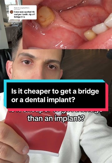 Bridge vs. Dental Implants: Cost and Long-Term Impact