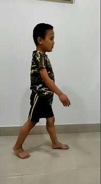 #Duchenne Muscular dystrophy #Lordotic posture #waddling gait due to gluteus muscle weakness