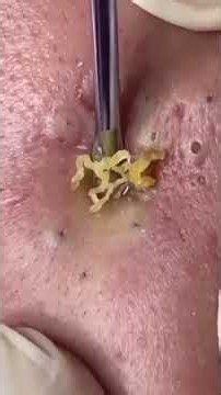 #acne #asmr #gross #pimple #pop #satisfying #skincare #trending #blackheads #video