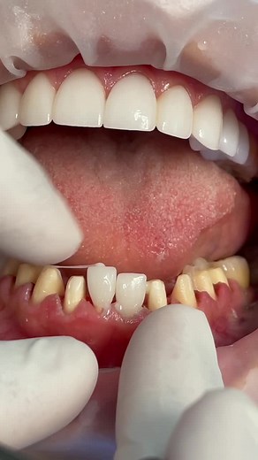 Gluing in porcelain veneers #dental #teeth #dentist #cosmetic #behindthesences #showtheprocess