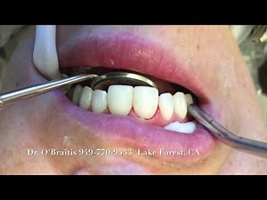 Teeth Bonding Procedure Teeth Bonding Before and After