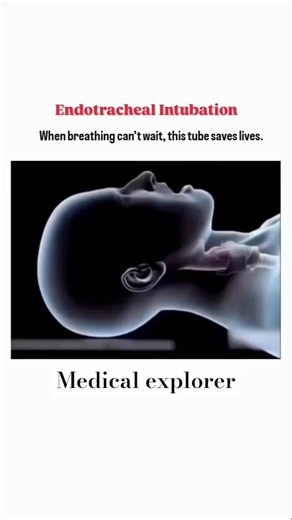 Endo tracheal intubation #shorts #lab