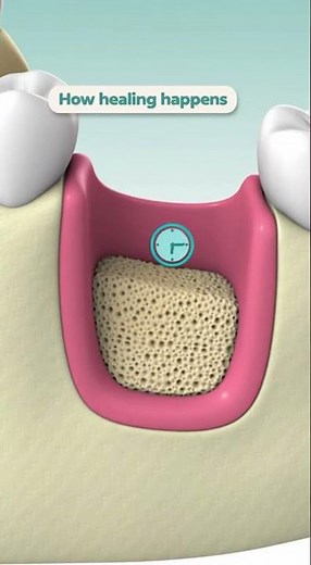 🦷 How Does Healing Work After a Tooth Extraction With a Bone Graft?