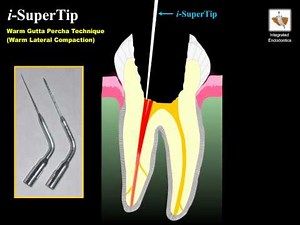Warm Gutta Percha Technique