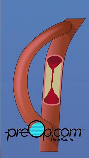🔍 PreOp® Coronary Artery Bypass Graft (CABG) On Pump 💡 ICU & Early Recovery
