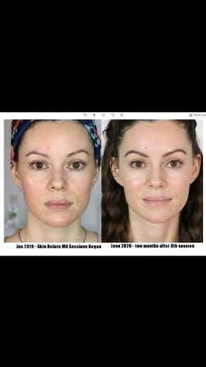 Microneedling Results - It Fixed My Skin (8 Sessions) #shorts