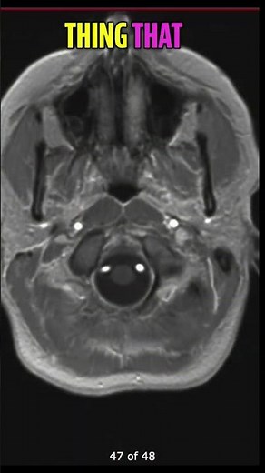 Brain Shrinkage & Black Holes MS MRI Scan Explained