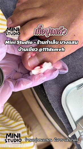 เนื้อปูดแล้ว 💅🏻 | Mini Studio - ตัดเล็บขบชลบุรี บางแสน #สอนตัดเล็บขบ #ตัดเล็บขบบางแสน #ร้านตัดเล็บขบบางแสน #ตัดเล็บขบชลบุรี #ตัดเล็บขบใกล้ฉัน