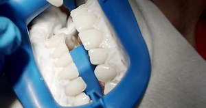Close up Oral hygiene and prophylactic cleaning. Female patient at hygiene teeth cleaning procedure in dentistry. Teeth Cleaning. Dentist making tooth cleaning for patient in dental modern clinic.