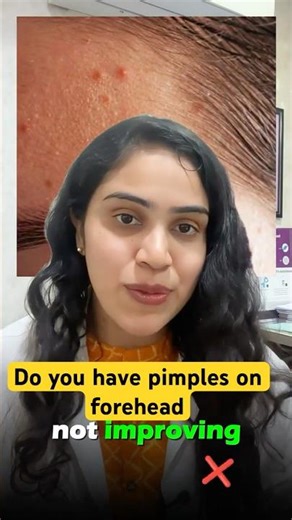 Do you have pimples on forehead ?