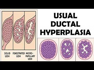 "Usual Ductal Hyperplasia | Microscopy & IHC Patterns | WHO 5th Edition Breast Pathology"