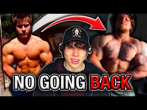 Blasting Steroids Turned Him Into An Acne Ridden Mess