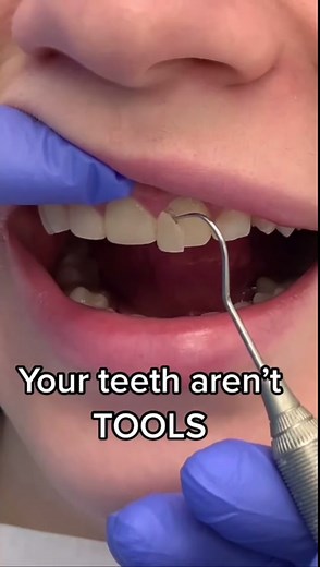 Crack tooth!! #crackbtooth #forces #cavity #dentalfilling