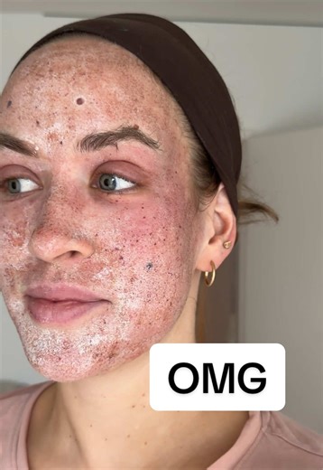 CO2 Laser Behandlung für Aknenarben und Fältchen