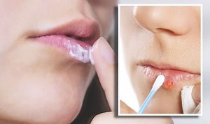 This Morning: Dr Chris explains how to treat cold sores