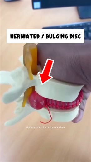 Feeling that sharp pain from a herniated disc? 🩻 The McKenzie Extension helps reduce disc pressure, centralize pain, and relieve sciatica by gently moving the disc material away from the nerve root. 🌿 Do it slowly, breathe deeply, and let your spine find its natural alignment again. #fblifestyle #BackPainRelief #Sciatica #McKenzieMethod #HerniatedDisc #PhysicalTherapy | Physical Therapy Session